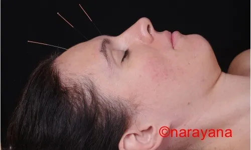 La acupuntura se ha demostrado muy efectiva para favorecer los procesos de adelgazamiento y para mejorar el aspecto externo.